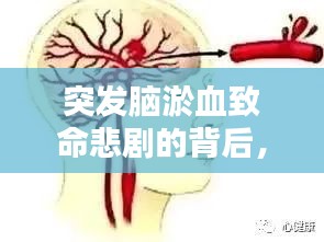突发脑淤血致命悲剧的背后,关于脑溢血的深度警示与探讨